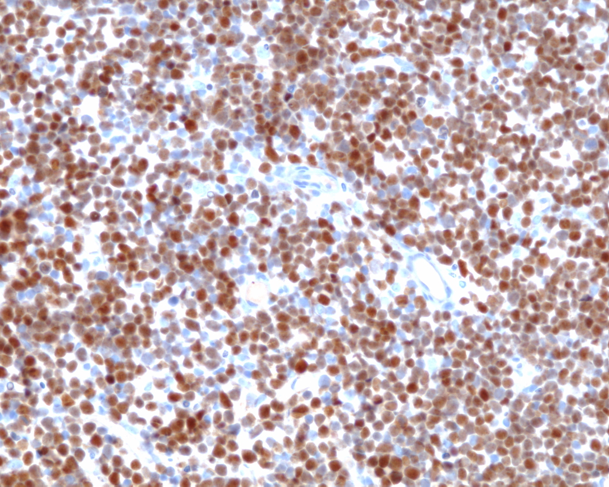 Immunohistochemical stain (TdT): Blasts are positive.
